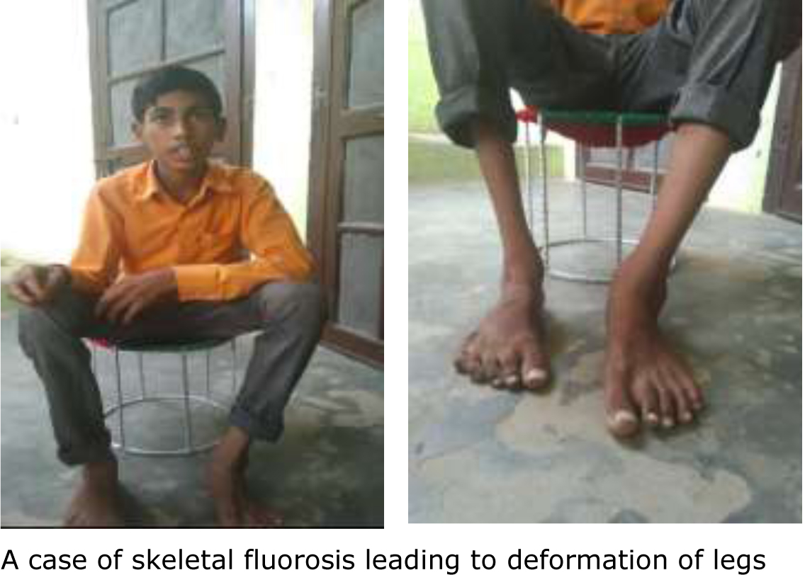 Radio brings fluorosis to light in Nuh