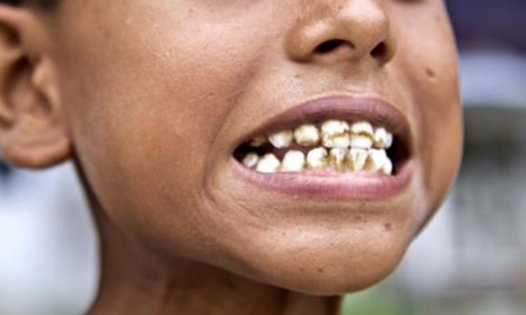 Dental-Fluorosis incidence